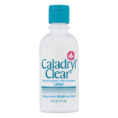 caladryl lotion for acne